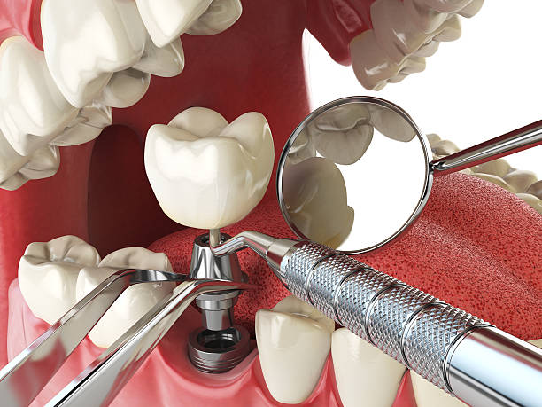 Best Teeth Whitening  in Springfield, GA